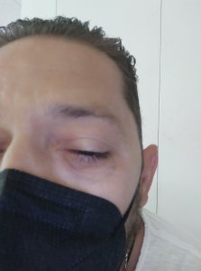 Τα εξανθήματα που προκλήθηκαν στο μάτι του κ. Ταγκαλάκη μετά την μετάγγιση που του έγινε