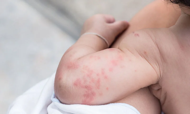 «Καμπανάκι» ΕΟΔΥ για παράλληλη έξαρση κοκκύτη και ιλαράς λόγω εμβολιαστικών κενών
