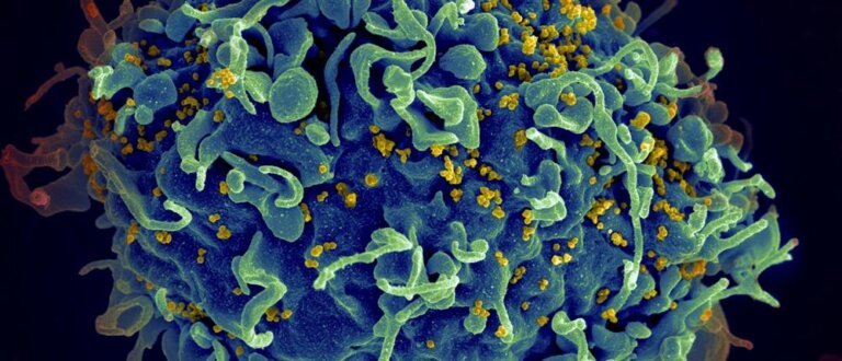 Πιο κοντά σε θεραπεία για τον HIV: Νέα τεχνολογία αποκαλύπτει τον ιό μέσα στα κύτταρα